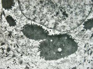 F, 11y. | ichthyosis hystrix type Curth-Macklin F, 11y. | ichthyosis hystrix type Curth-Macklin